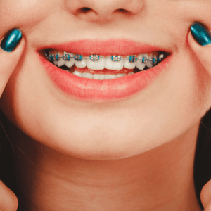 Traditional Braces