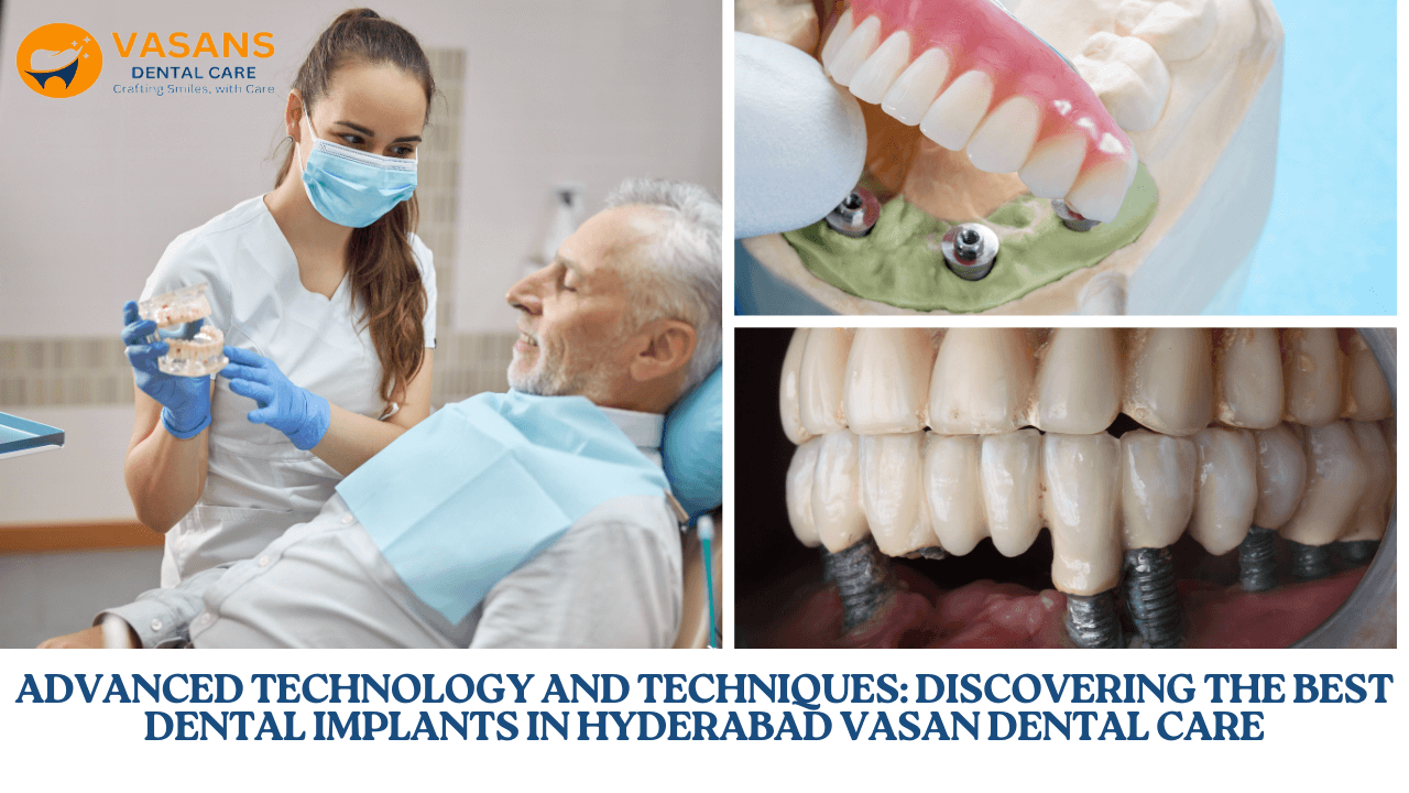 Best Dental Implants in Hyderabad Vasan Dental Care